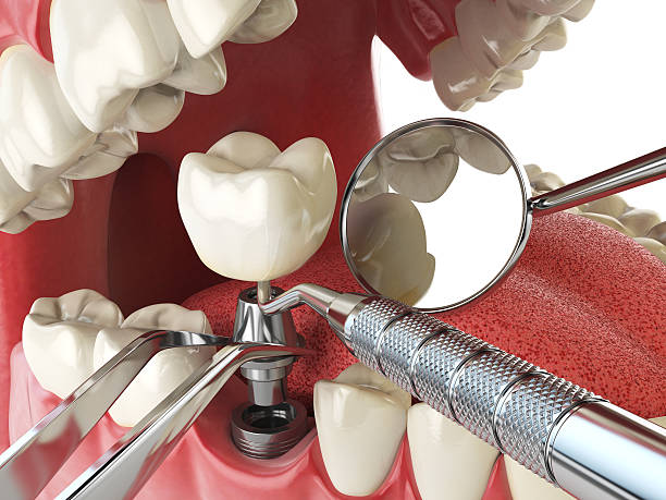Best Broken or Cracked Tooth Emergency Dentist in Goulds, FL